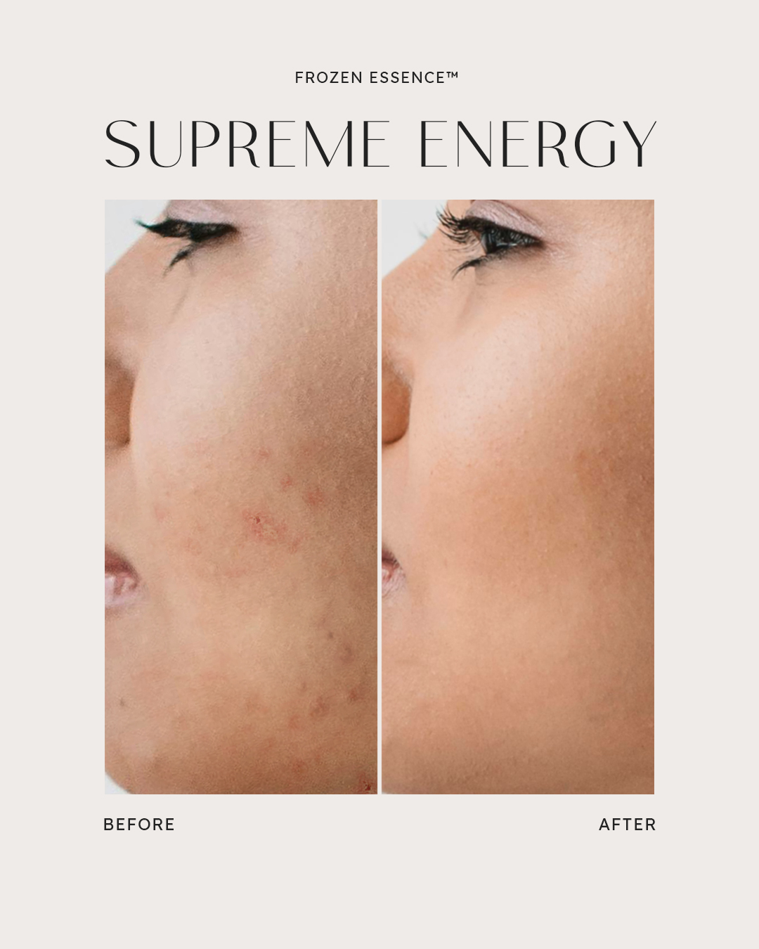 Before and after — Supreme Energy · Blemishes calmed
