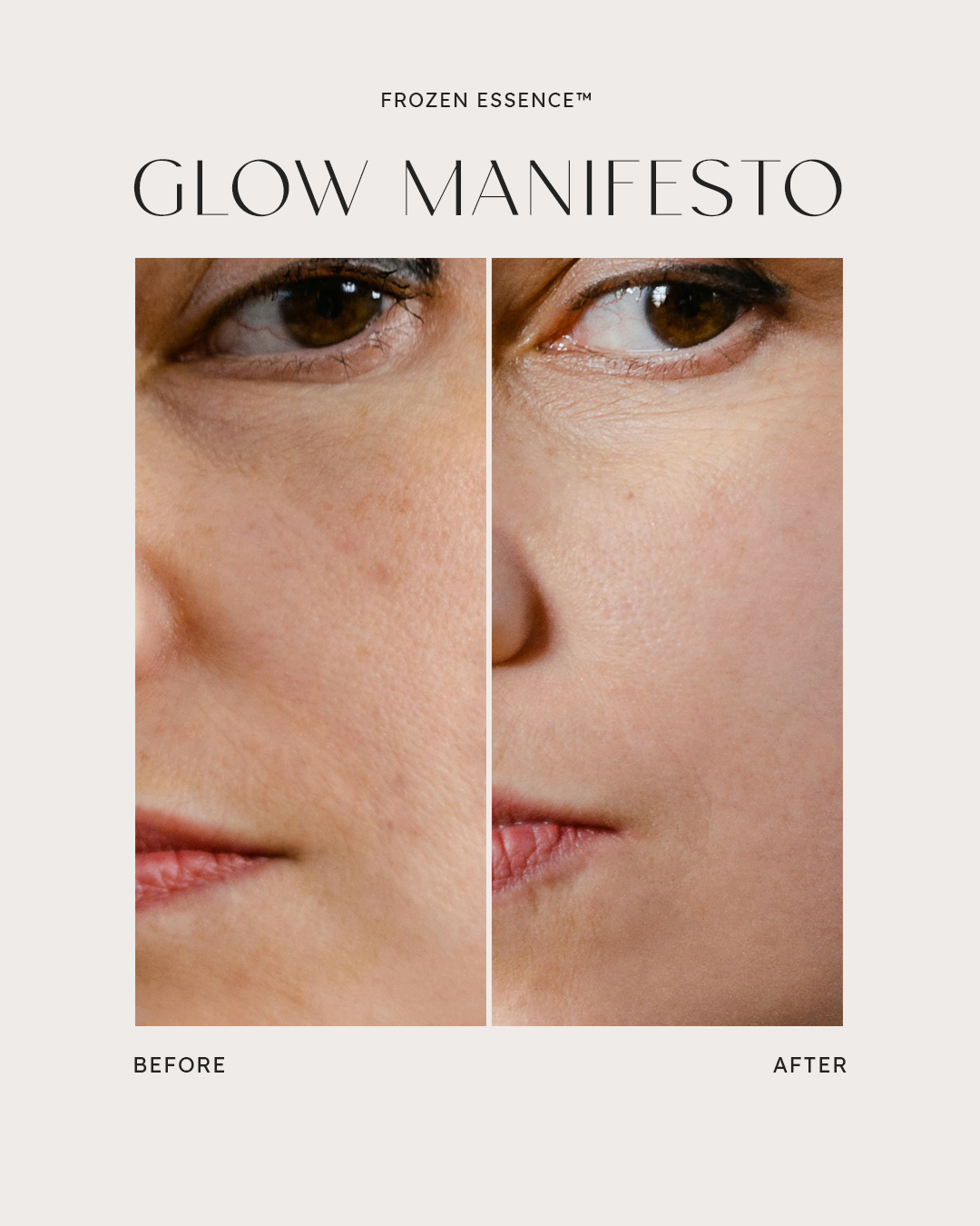 Before and after — Glow Manifesto · Smoothness, lower face