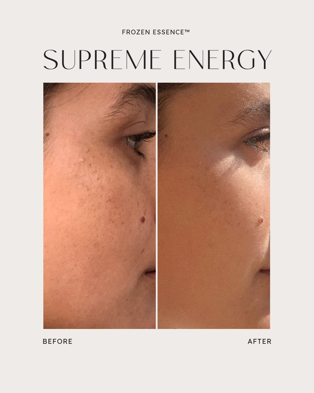 Before and after — Supreme Energy · Pores refined