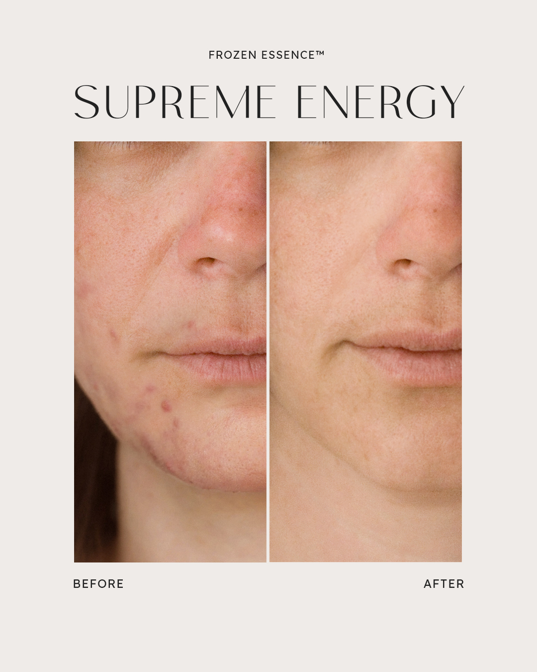 Before and after — Supreme Energy · Redness & breakouts