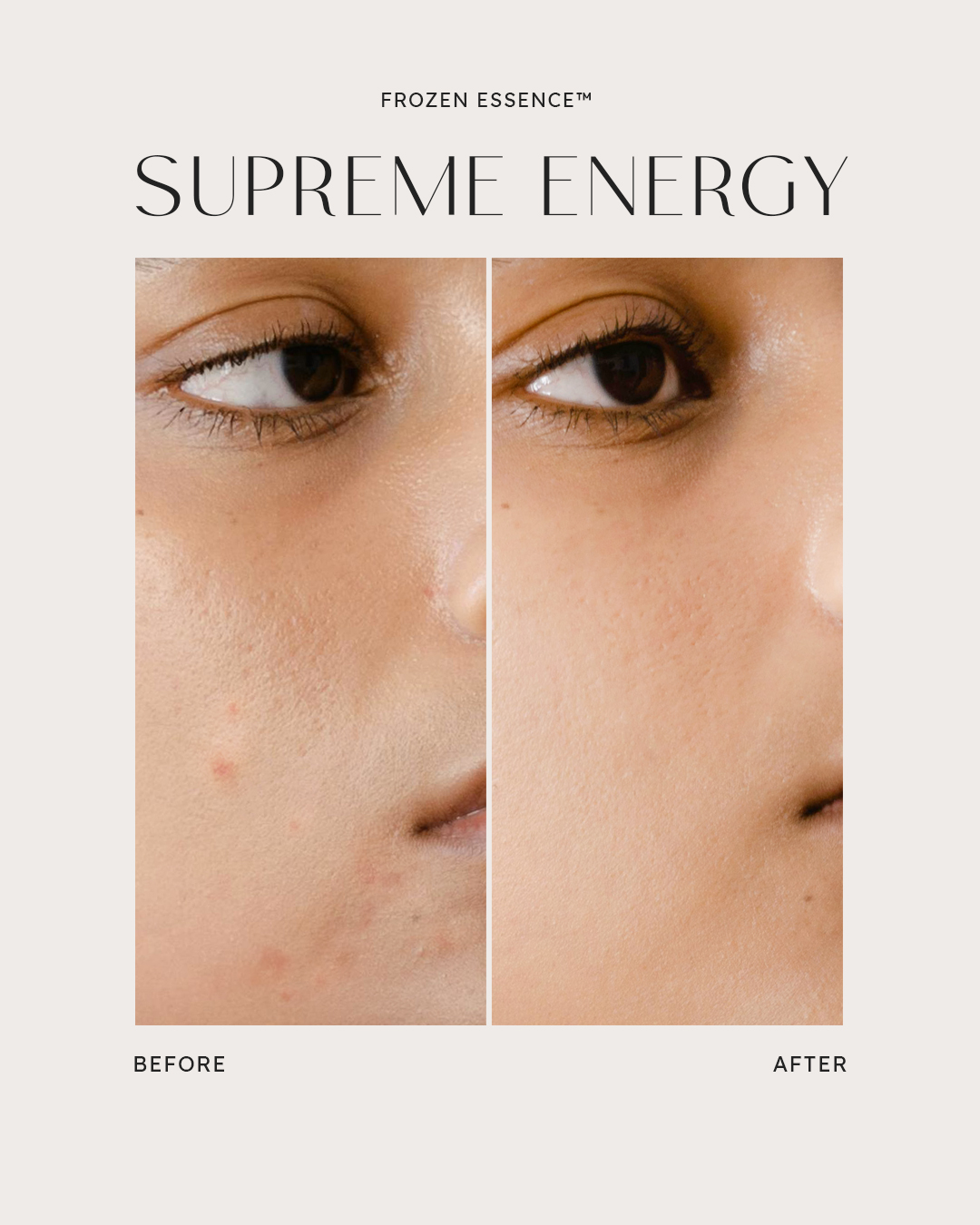Before and after — Supreme Energy · Even, refined cheek