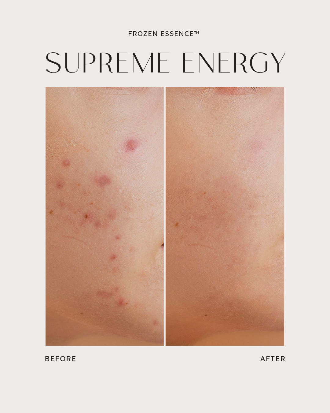 Before and after — Supreme Energy · Post-acne marks faded