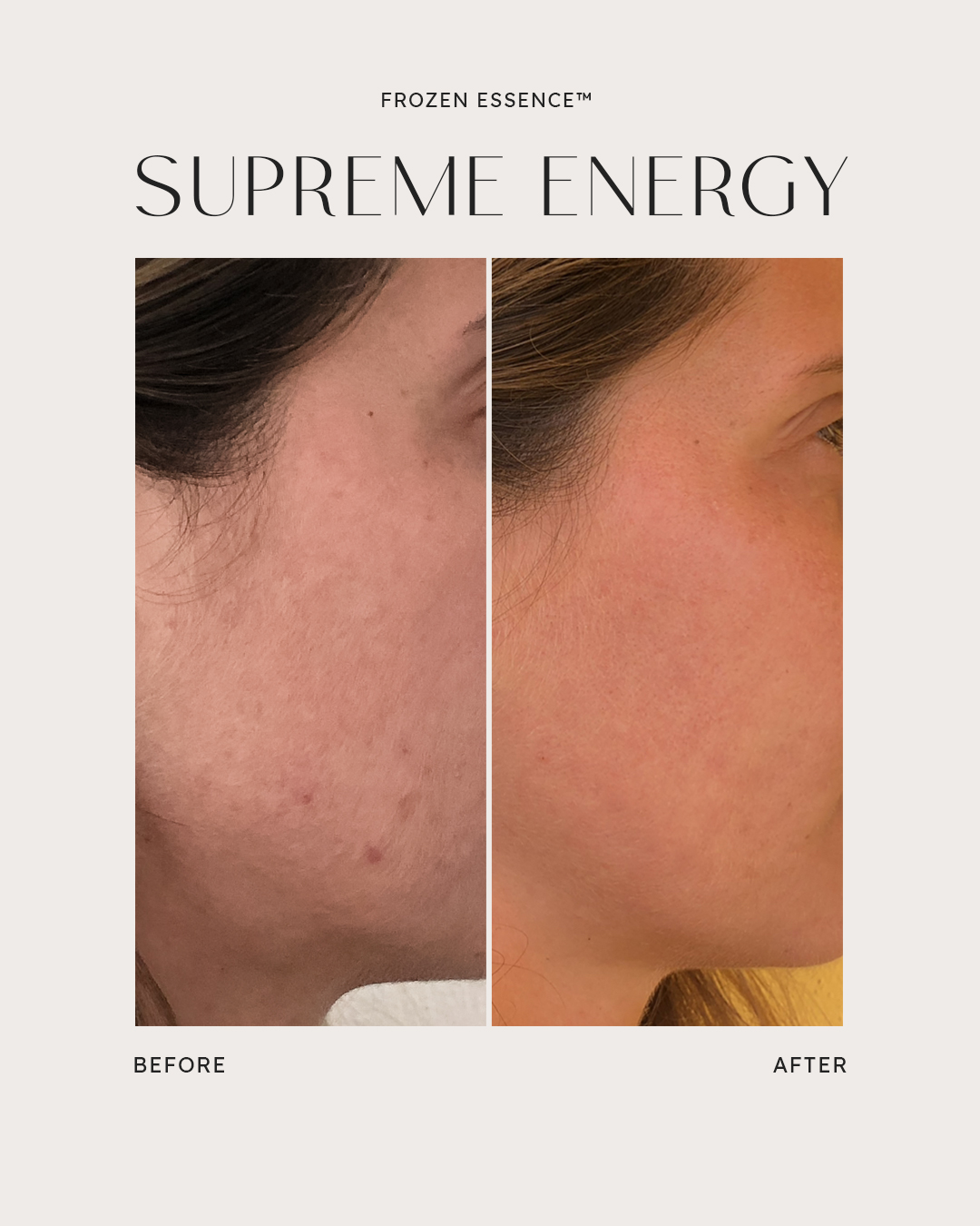 Before and after — Supreme Energy · Acne scarring softened