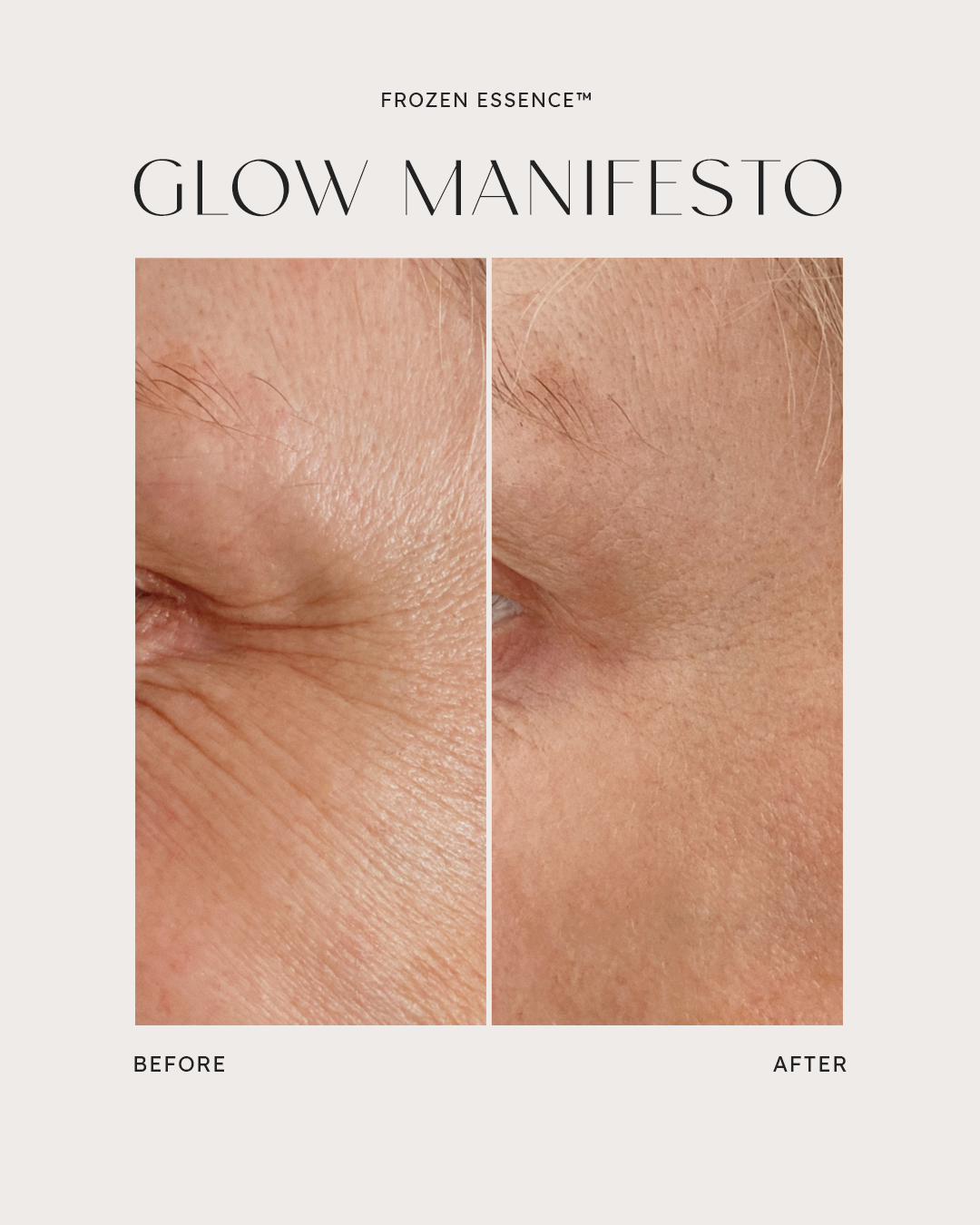 Before and after — Glow Manifesto · Crow's feet